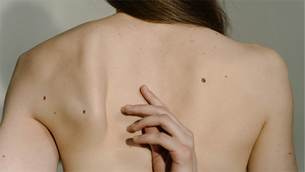 How to tell if a mole is cancerous: the ABCDE rule explained
