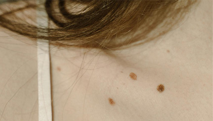 Basal Cell vs Squamous Cell Carcinoma: What’s the Difference?