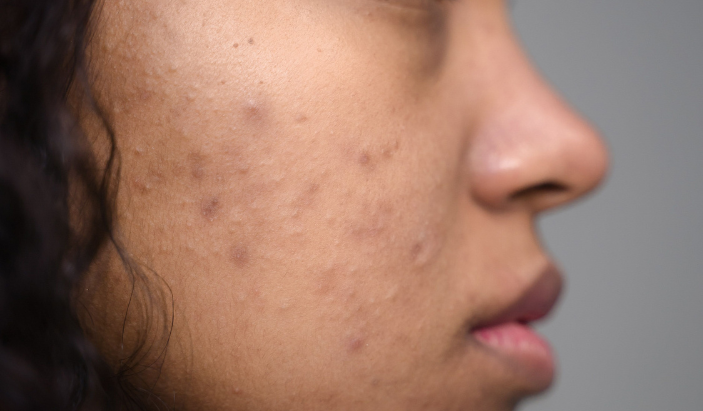 Close-up of a patient with stubborn acne blemishes on their cheek seeking medical treatment from a dermatologist in Cleveland, TN.