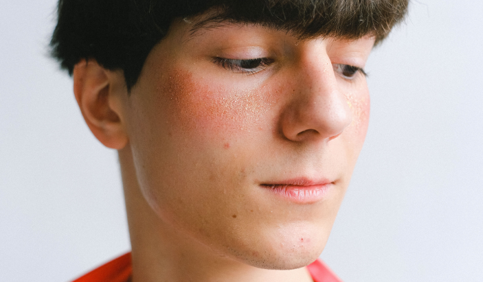 Young male patient experiencing facial redness and rosacea-like flushing on the cheeks, illustrating sensitive skin treatments.