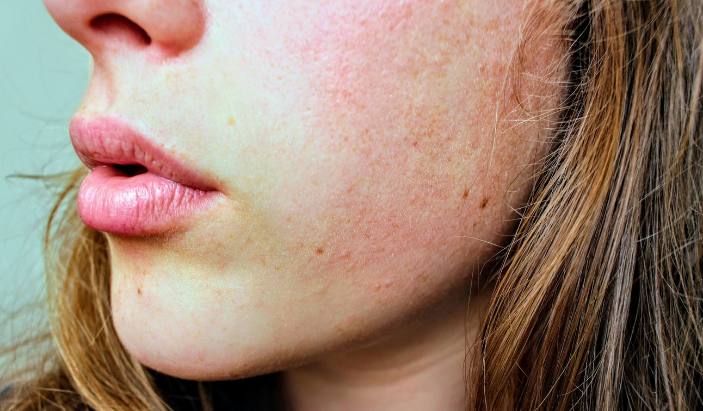 The 4 Types of Rosacea Explained: Which Type Do You Have?