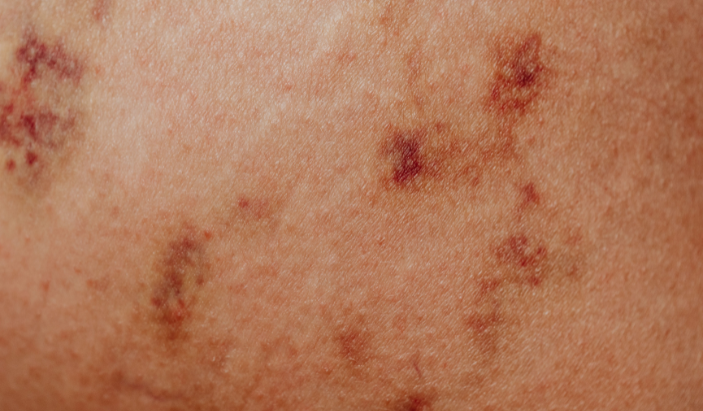 Close-up of sun-damaged skin with multiple red and brown spots requiring a professional skin check in Kimball TN.