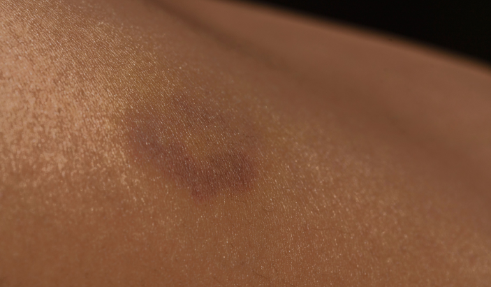 Close-up of an irregular dark skin discoloration or asymmetrical mole needing evaluation by a Cleveland TN dermatologist.