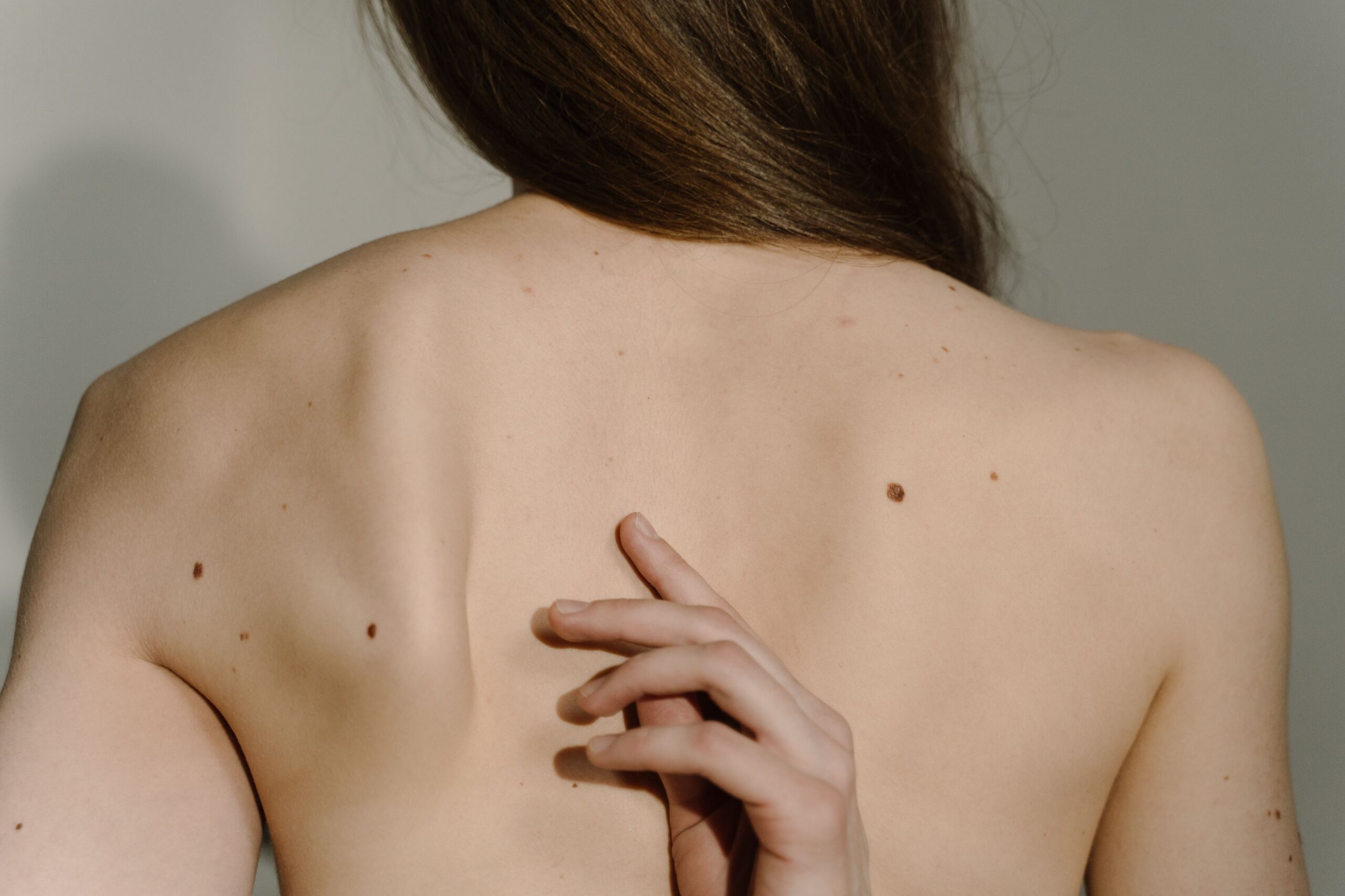 Close-up of multiple moles and freckles on a woman's bare back