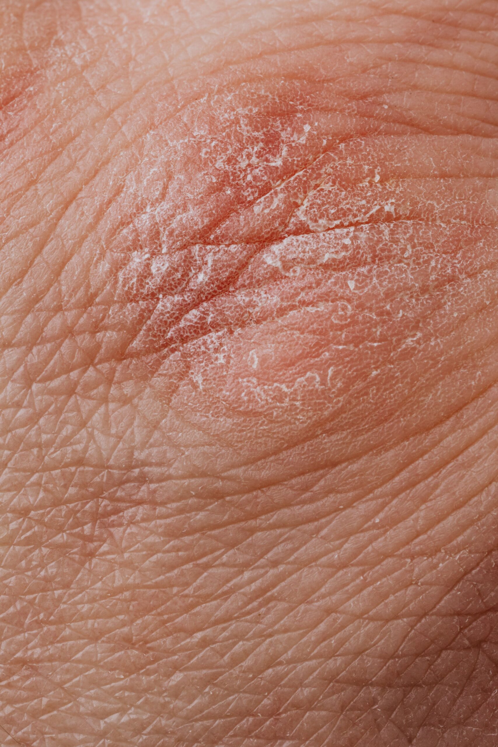 Close-up of dry cracked skin from a psoriasis eczema summer flare