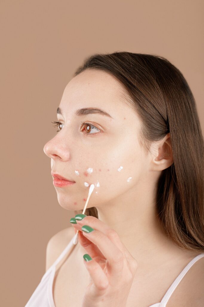 Teen applying acne treatment to face before back-to-School skin check dermatologist visit in Cleveland TN