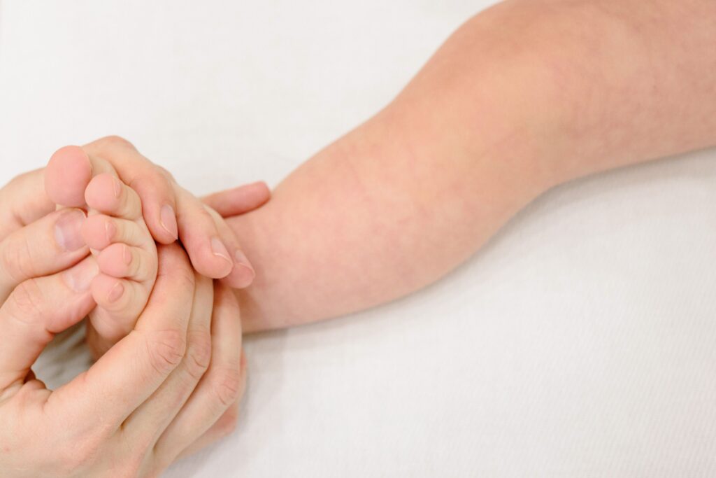 Parent holding a child's arm with a bug bite skin reaction near Kimball TN dermatology clinic
