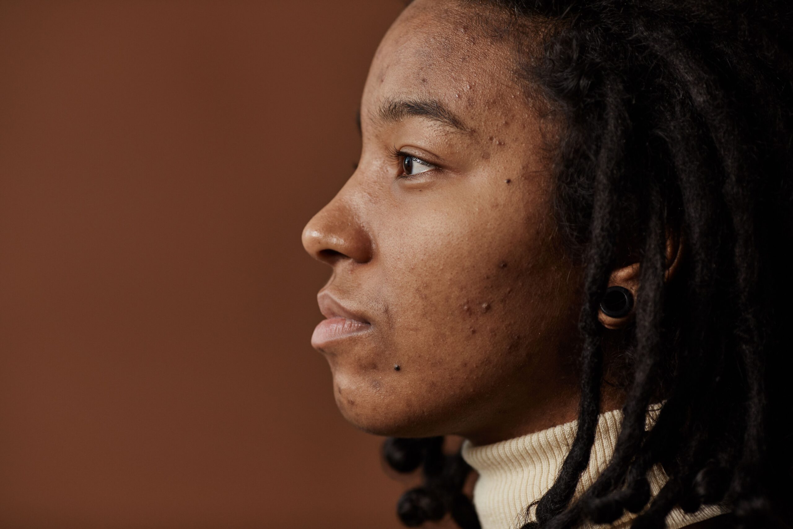 Adult Acne: 5 Surprising Causes and How to Treat It